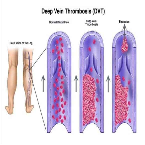 prevent-deep-vein-thrombosis-travel
