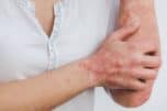 psoriasis vs eczema
